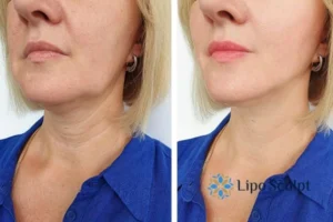 Double chin before and after Hi-Fu treatment 4 Book your double chin treatment Hall Green today! We are here to help!