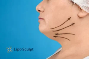 Double chin before and after Hi-Fu treatment 3 Boost your confidence with a Double chin treatment Hall Green