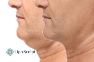 Double chin before and after Hi-Fu treatment 2 Double chin treatment Hall Green from Lipo Sculpt - feel more confident today!