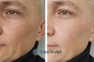 How to Fight Aging Symptoms 3 Fight Aging Symptoms Hall Green With HIFU and Morpheus8 Today!