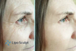 How to Fight Aging Symptoms 2 Do you want to Fight Aging Symptoms Hall Green? Contact Lipo Sculpt today!