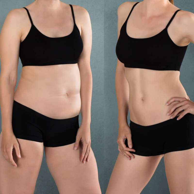 Does Fat Freezing at Home Work? DIY Devices vs Professional Cryolipolysis 2 before and after Cryolipolysis Hall Green