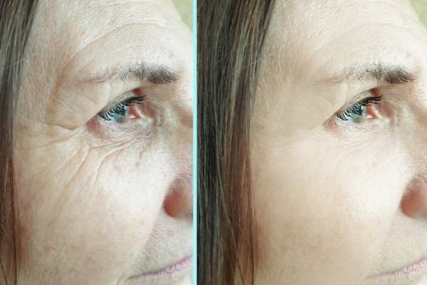 Why Do People Choose HIFU for a Non-Surgical Facelift? 4 How long can HIFU results last Hall Green?