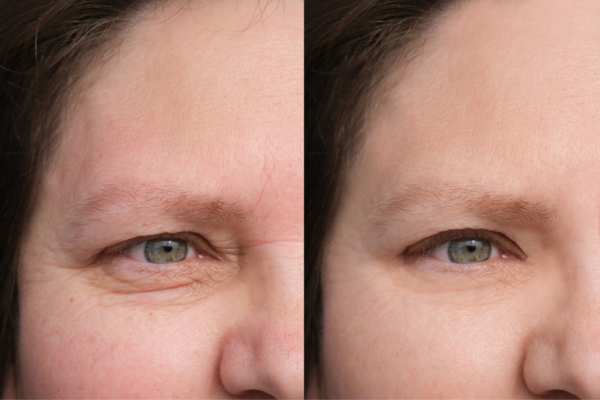 HIFU vs Botulinum Toxin: Understanding the Differences 4 How long do HIFU results last Hall Green?