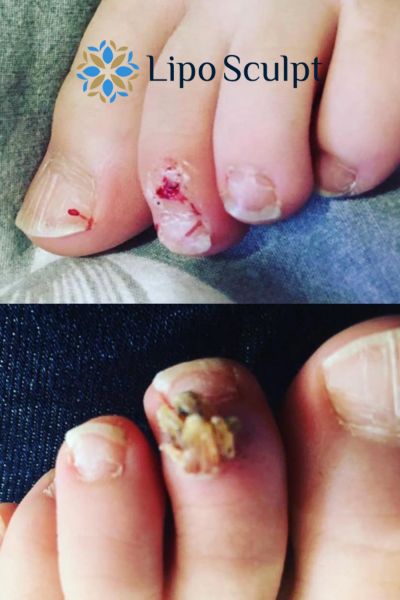 Wart removal customer results from Lipo Sculpt Hall Green